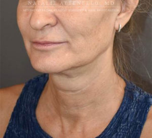Facelift Case 4655 Before Photo Facelift