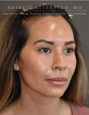 Hairline Lowering/Forehead Reduction Case 4734 Before Photo Hairline Lowering/Forehead Reduction