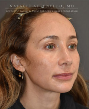 Hairline Lowering/Forehead Reduction Case 4741 Before Photo Hairline Lowering/Forehead Reduction