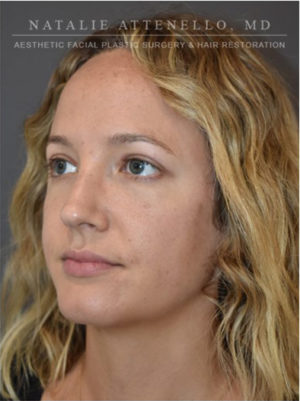 Blepharoplasty Case 4709 After Photo Blepharoplasty