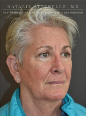 Blepharoplasty Case 4717 After Photo Blepharoplasty