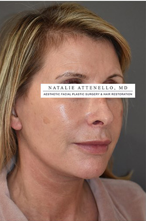 Facelift Case 4660 After Photo Facelift
