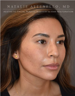 Hairline Lowering/Forehead Reduction Case 4734 After Photo Hairline Lowering/Forehead Reduction