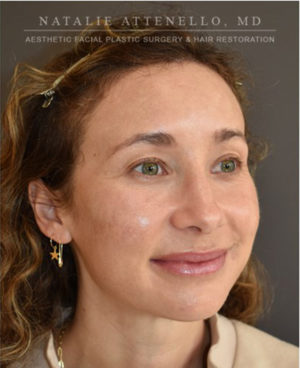 Hairline Lowering/Forehead Reduction Case 4741 After Photo Hairline Lowering/Forehead Reduction