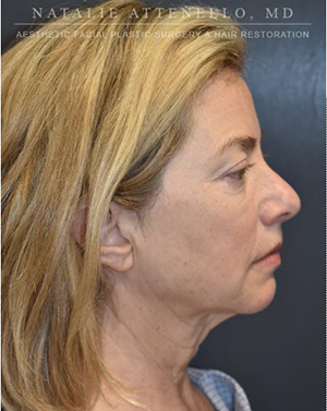 Facelift