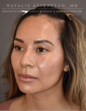 Hairline Lowering/Forehead Reduction Case 4734 Before Photo Hairline Lowering/Forehead Reduction