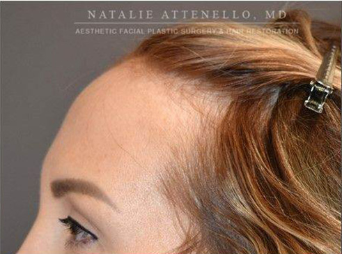 Hairline Lowering/Forehead Reduction