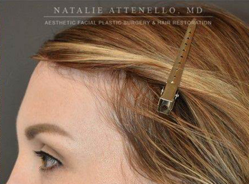 Hairline Lowering/Forehead Reduction