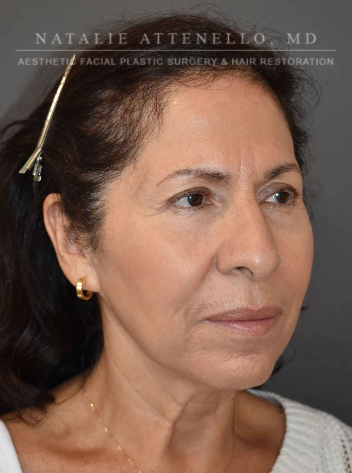 Blepharoplasty