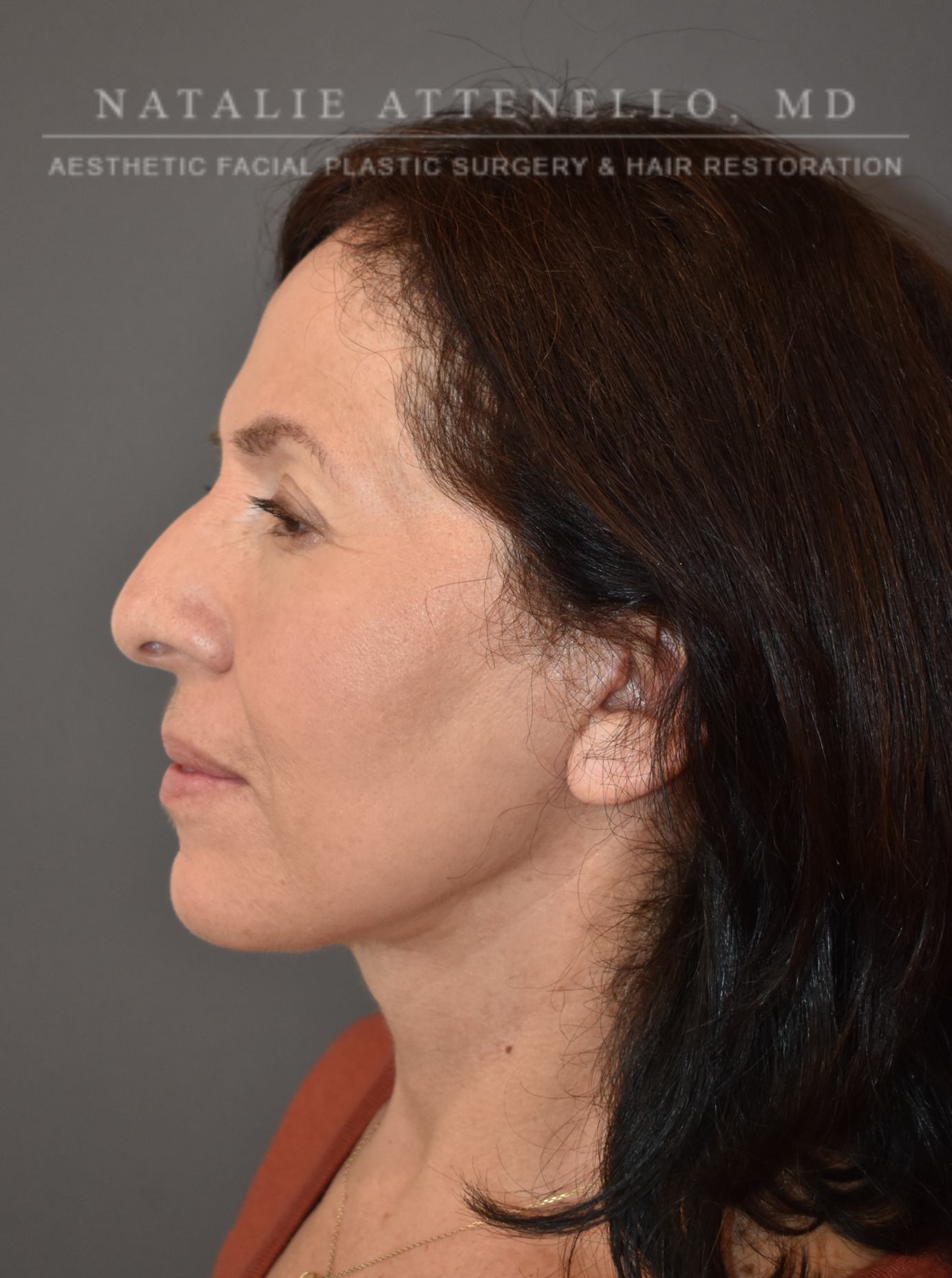 Blepharoplasty