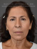 Blepharoplasty