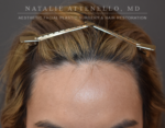 Hairline Lowering/Forehead Reduction