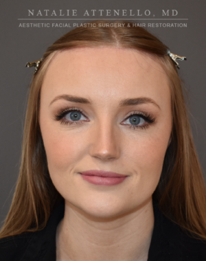 Hairline Lowering/Forehead Reduction Case 4934 After Photo Hairline Lowering/Forehead Reduction