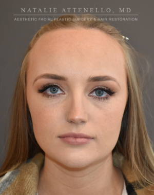 Hairline Lowering/Forehead Reduction Case 4934 Before Photo Hairline Lowering/Forehead Reduction