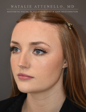 Hairline Lowering/Forehead Reduction Case 4934 After Photo Hairline Lowering/Forehead Reduction