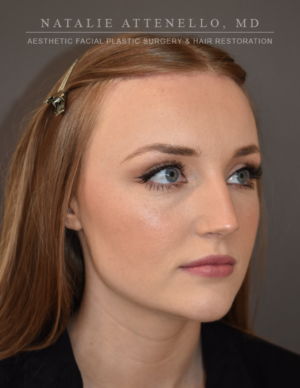 Hairline Lowering/Forehead Reduction Case 4934 After Photo Hairline Lowering/Forehead Reduction