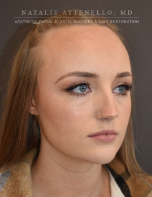 Hairline Lowering/Forehead Reduction Case 4934 Before Photo Hairline Lowering/Forehead Reduction