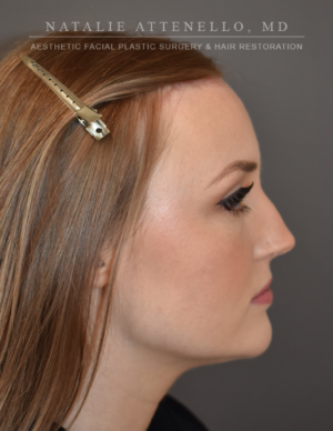 Hairline Lowering/Forehead Reduction Case 4934 After Photo Hairline Lowering/Forehead Reduction
