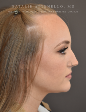 Hairline Lowering/Forehead Reduction Case 4934 Before Photo Hairline Lowering/Forehead Reduction