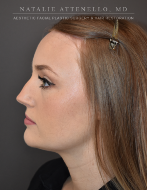 Hairline Lowering/Forehead Reduction Case 4934 After Photo Hairline Lowering/Forehead Reduction
