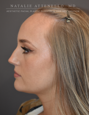 Hairline Lowering/Forehead Reduction Case 4934 Before Photo Hairline Lowering/Forehead Reduction
