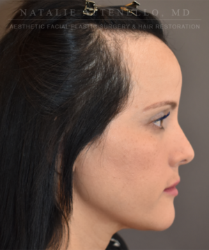 Hairline Lowering/Forehead Reduction
