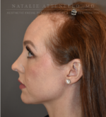 Hairline Lowering/Forehead Reduction