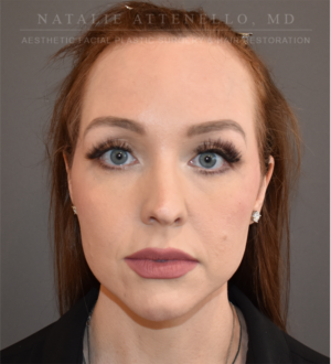 Hairline Lowering/Forehead Reduction Case 5177 Before Photo Hairline Lowering/Forehead Reduction