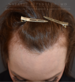 Hairline Lowering/Forehead Reduction