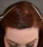 Hairline Lowering/Forehead Reduction