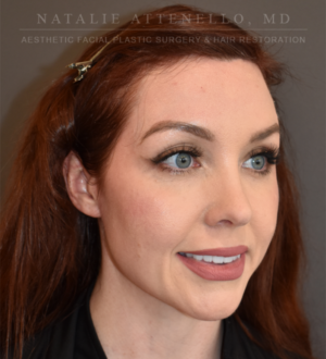 Hairline Lowering/Forehead Reduction Case 5177 After Photo Hairline Lowering/Forehead Reduction