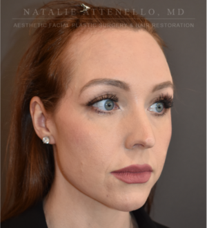 Hairline Lowering/Forehead Reduction Case 5177 Before Photo Hairline Lowering/Forehead Reduction