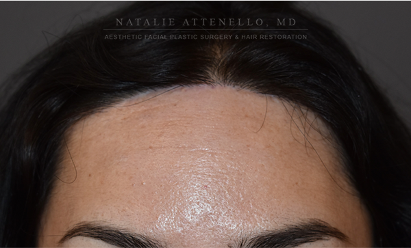 Forehead Reduction:Hairline Lowering photo
