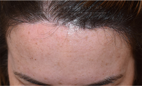 Forehead Reduction:Hairline Lowering photo1