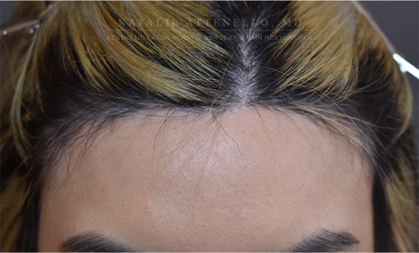 Forehead Reduction:Hairline Lowering photo2