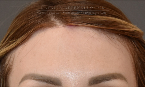 Forehead Reduction:Hairline Lowering photo3