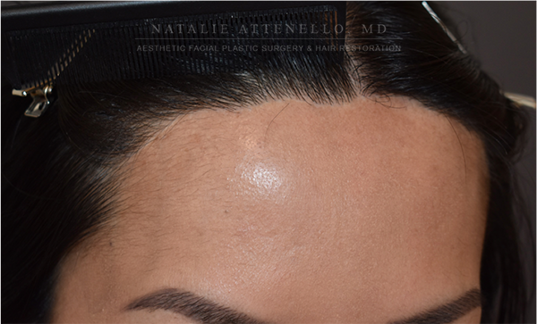 Forehead Reduction:Hairline Lowering photo4