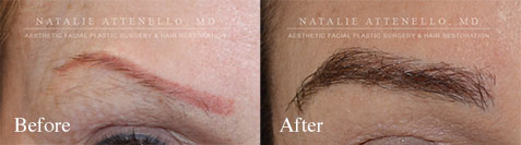 Eyebrow Transplantation performed by Dr. Attenello Before and After Photos
