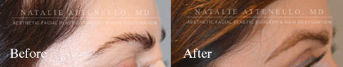 partial eyebrow transplant completed by Dr. Attenello in Beverly Hills, CA