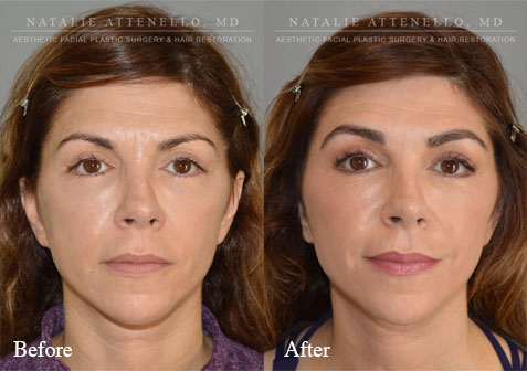 fuller eyebrow after hair transplant surgery performed by Dr. Attenello in Beverly Hills, CA