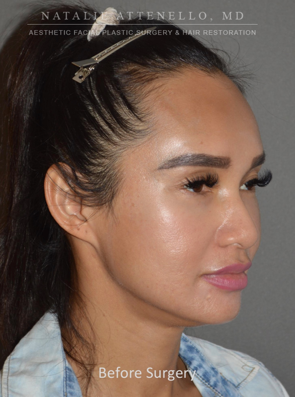 Before photo of a big forehead reduction procedure by Dr. Attenello in Beverly Hills