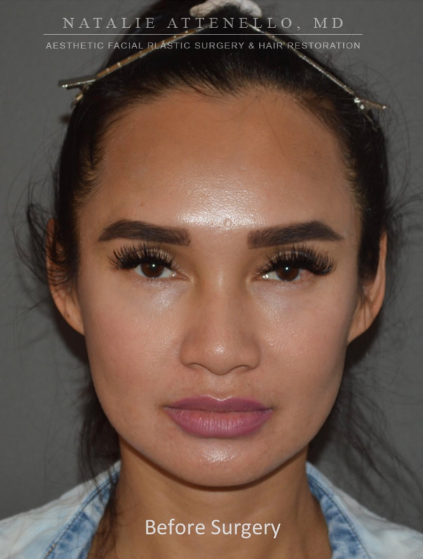 Before picture of one-stage forehead reduction procedure by Dr. Natalie Attenello