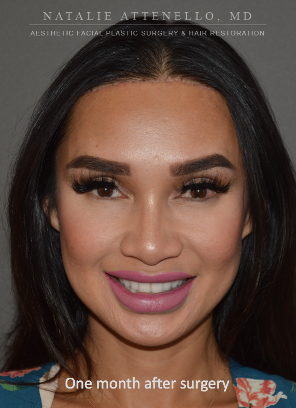 Final results of a one-stage forehead reduction procedure by plastic surgeon Dr. Attenello