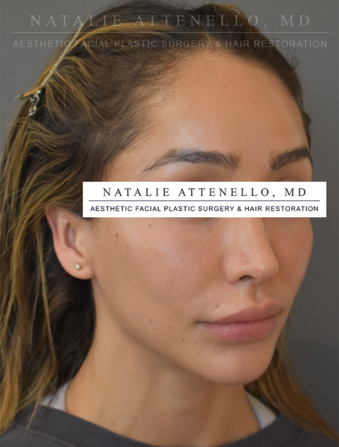 Beverly Hills Hairline Lowering/Forehead Reduction Before and After Photos Los Angeles Plastic