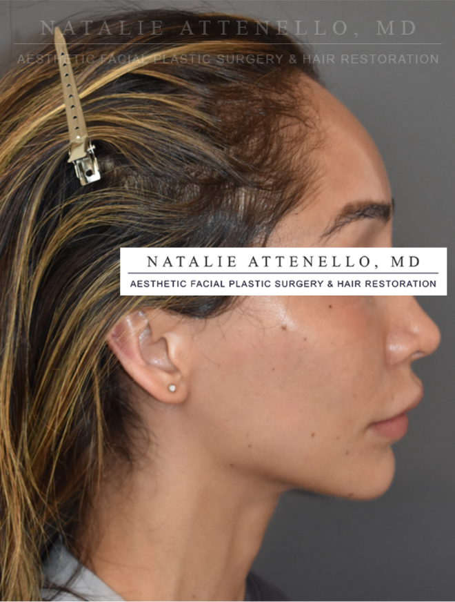 Beverly Hills Hairline Lowering/Forehead Reduction Before and After Photos Los Angeles Plastic