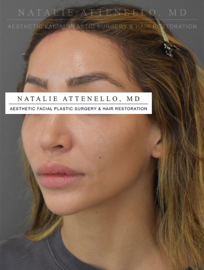 Beverly Hills Hairline Lowering/Forehead Reduction Before and After Photos Los Angeles Plastic