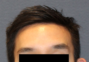 Hairline Lowering/Forehead Reduction Case 3293 After Photo Hairline Lowering/Forehead Reduction