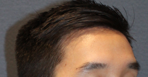 Hairline Lowering/Forehead Reduction Case 3293 After Photo Hairline Lowering/Forehead Reduction