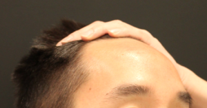 Hairline Lowering/Forehead Reduction Case 3293 Before Photo Hairline Lowering/Forehead Reduction