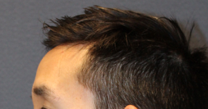Hairline Lowering/Forehead Reduction Case 3293 After Photo Hairline Lowering/Forehead Reduction